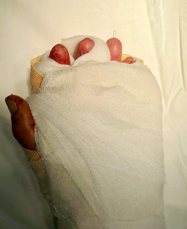 Bàn tay trái sau phẫu thuật, ngón tay IV và V bàn tay trái hồng, ấm và hồi lưu vi tuần hoàn tốt.