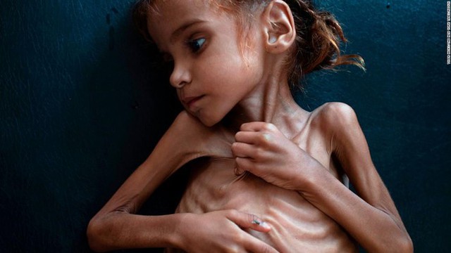 Bức ảnh chụp Amal Hussain, 7 tuổi, bị suy dinh dưỡng nặng. Ảnh: New York Times.