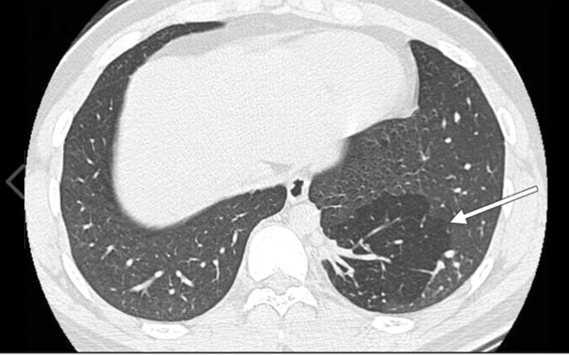 Hình ảnh chụp cho thấy có một thuỳ phổi biệt lập bên phổi trái của bà C