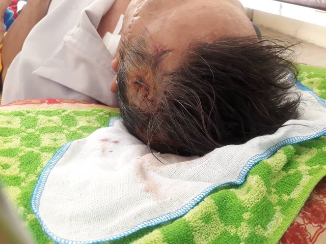 Ông Đ. bị đối tượng đập nhiều nhát vào đầu.
