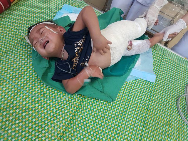 B&eacute; Lữ Tuấn Anh bị bỏng to&agrave;n th&acirc;n nghi&ecirc;m trọng.