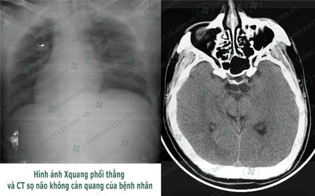 
Bệnh nhân được chẩn đoán hôn mê do hạ đường huyết kéo dài, đái tháo đường tuýp 2, viêm phổi nặng. Ảnh: BVCC
