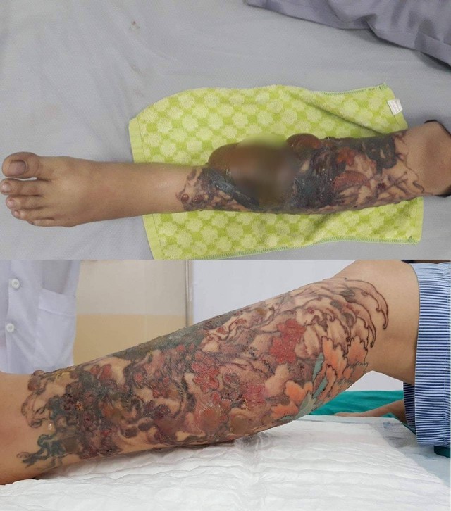 
Vùng cẳng chân bị bỏng do xoá xăm bằng laser của nữ bệnh nhân trước và sau khi điều trị. Ảnh: BVCC
