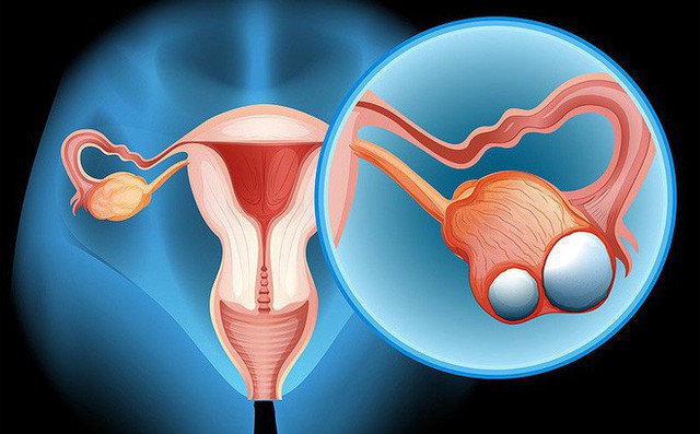 Sử dụng thuốc tránh thai trong thời gian dài có liên quan với giảm nguy cơ ung thư buồng trứng và ung thư nội mạc tử cung, trưởng nhóm nghiên cứu Kara Michels cho biết.