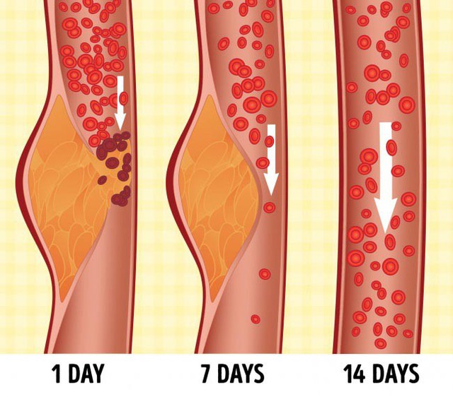 
DASH giúp giảm huyết áp, giảm cholesterol, phòng ngừa đột quỵ, suy tim…
