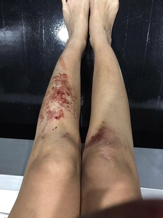 Cơ thể của nữ DJ đều bị xước xát, rớm máu.