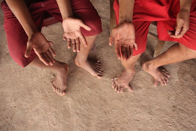 hai anh em c&ugrave;ng b&agrave; ngoại v&agrave; mẹ đều c&oacute; 14 ng&oacute;n ch&acirc;n v&agrave; 12 ng&oacute;n tay