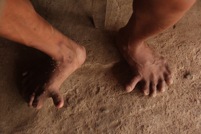 
Bị dị tật n&ecirc;n những th&agrave;nh vi&ecirc;n trong gia đ&igrave;nh anh Hồ Cao đều kh&ocirc;ng thể đi gi&agrave;y, d&eacute;p
