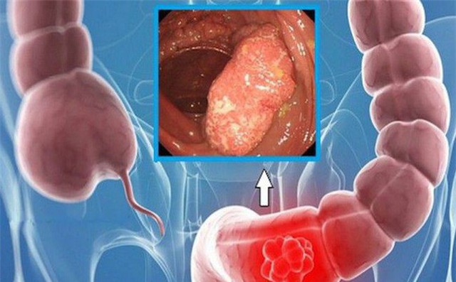 
Polyp trực tràng ở trẻ em nếu chủ quan sẽ biến chứng thành ung thư đại trực tràng
