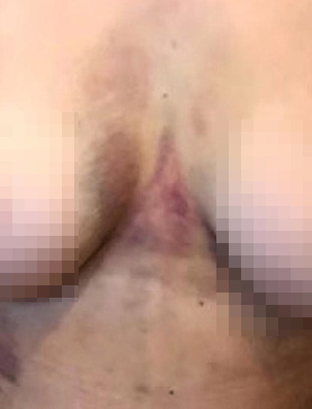  The chest, a seemingly unrelated part of the surgery, was also bruised. 