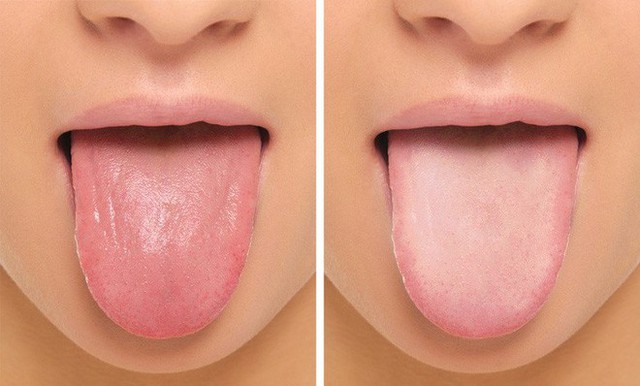 
Nồng độ myoglobin thấp có thể làm cho lưỡi bị đau, nhẵn và sưng.
