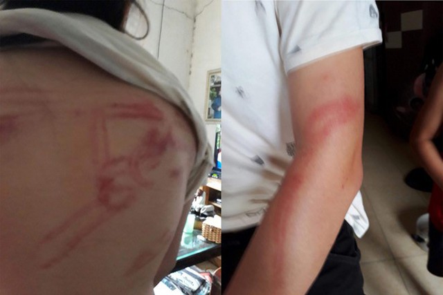
Hình ảnh cháu bé nghi bị bố bạo hành dã man tại phường Phúc Đồng, Long Biên, Hà Nội.     Ảnh: H.CHI
