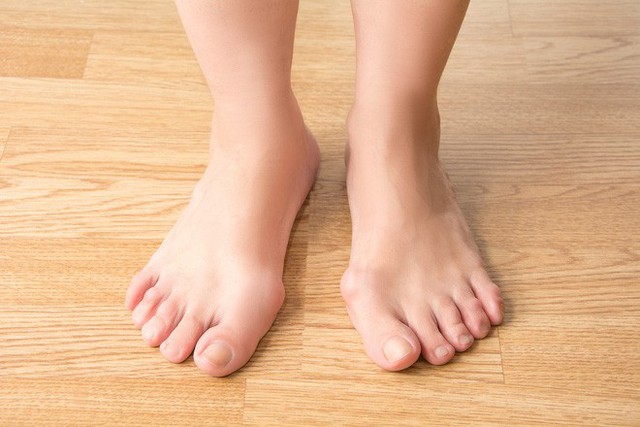 
Nhiều phụ nữ cũng bị mắc chứng vẹo ngón chân cái do mang giày cao gót. (Ảnh: Internet)
