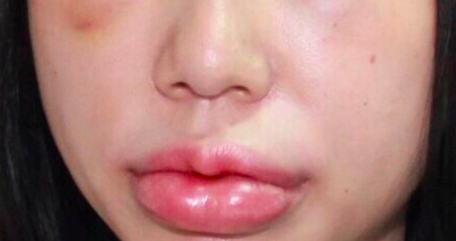 Hình ảnh bệnh nhân T.T.H bị biến chứng khi tiêm chất làm đầy (filler) ở môi, mắt và thái dương đến khám và điều tri tại Bệnh viện Da liễu Trung ương ngày 6/6