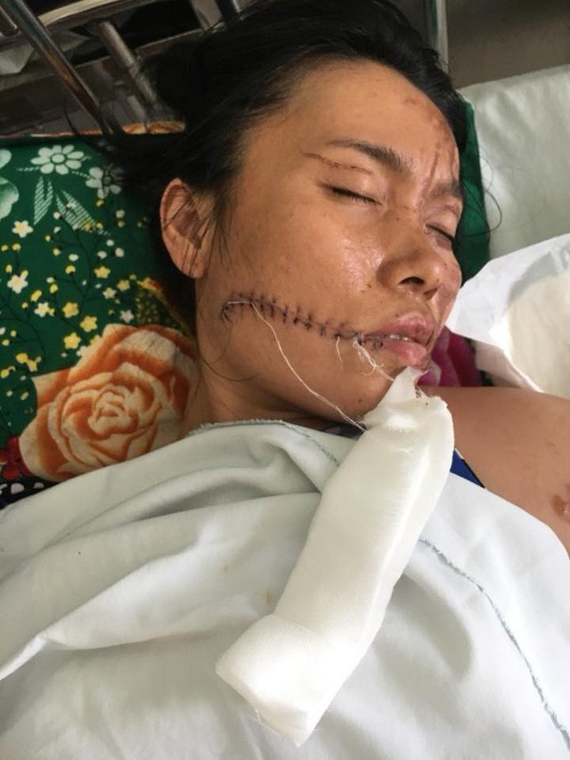 
Chị M. tại bệnh viện, ngoài những vết bỏng trên thân thể, mặt chị còn bị vết cắt sâu phải khâu 18 mũi.
