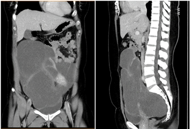 
Hình CT scan khối u chiếm gần toàn bộ ổ bụng, từ vùng chậu lên đến sát gan
