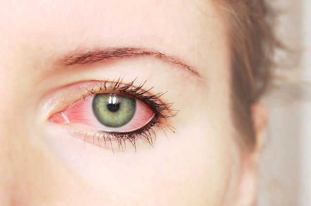 
Mắt đỏ là dấu hiệu cảnh báo mắt bị kích ứng, thành mạch máu sưng phồng.
