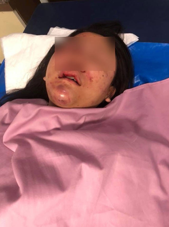 Nạn nh&acirc;n đang được điều trị tại bệnh viện.