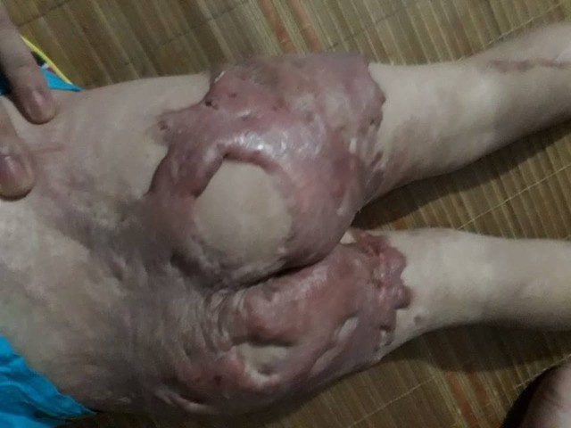 
Những tảng da bị bỏng của bé Việt Hoàng dày bì như da trâu, sưng và ngứa rát khiến bé gãi trầy xước, chảy cả máu. Ảnh: Gia đình cung cấp.
