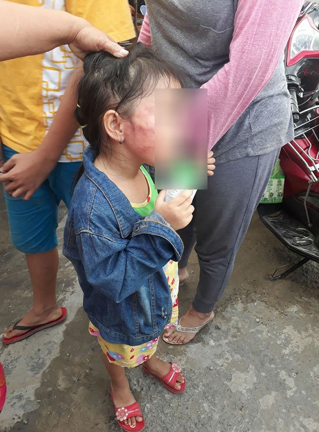 
Vết bầm t&iacute;m tr&ecirc;n mặt của b&eacute; D. nghi bị bảo mẫu bạo h&agrave;nh.
