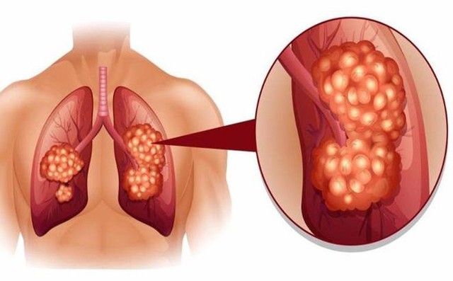 Ung thư phổi - nguyên nhân hàng đầu gây tử vong ở nam giới.
