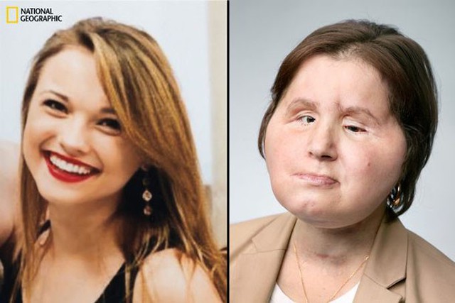 Khuôn mặt trước đây của Katie (trái) và hiện tại sau khi được cấy ghép (phải). Ảnh: National Geographic.