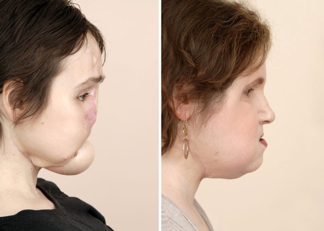 Gương mặt của Katie trước và sau khi trải qua ca đại phẫu cấy ghép hồi năm ngoái. Ảnh: National Geographic.