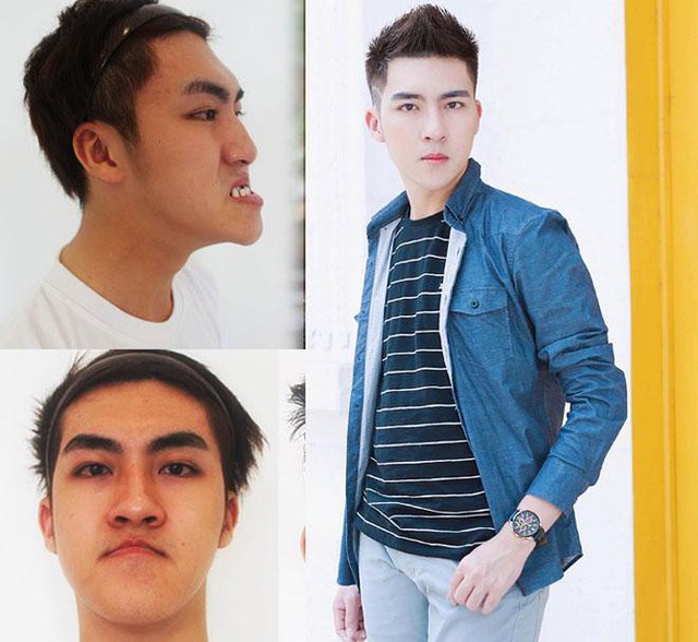 Mạc Hải Ninh lột xác sau khi phẫu thuật thẩm mỹ