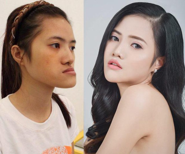 Hoàng Hiên - một cô gái thoát kiếp mặt lưỡi cày nhờ thẩm mỹ
