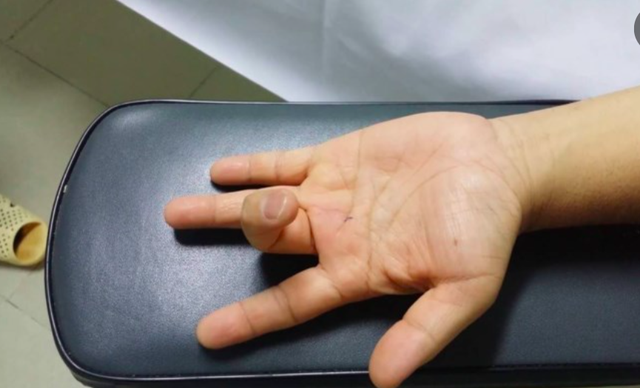 
Mắc ngón tay lò xo, mỗi lần gấp hay duỗi ngón tay đối với bệnh nhân trở nên rất khó khăn.     Ảnh: TL
