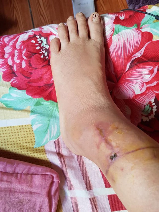 
Vết thương ở vùng chân trái của chị Oanh.
