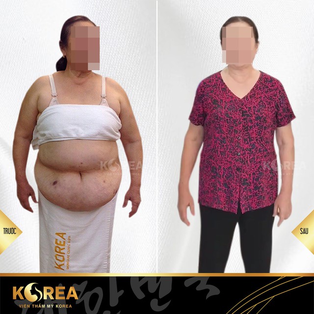 
Cô Hồng- Khách hàng giảm béo tại VTM Korea sau khi giảm 12kg mỡ xấu, các triệu chứng bệnh khớp và mỡ máu cũng giảm rõ rệt.
