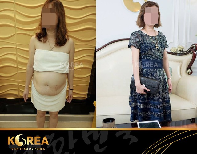 
Chị Hải- Khách hàng giảm béo tại VTM Korea sau khi giảm 38 cm vòng bụng lấy lại vóc dáng thon gọn.
