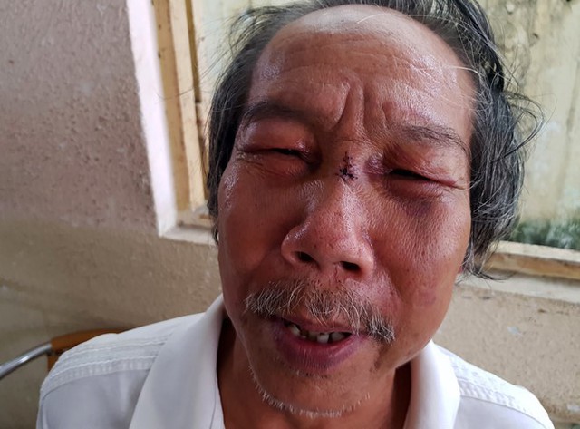 Nh&agrave; thơ 68 tuổi bị đ&aacute;nh g&atilde;y sống mũi. Ảnh: L&ecirc; Trai.