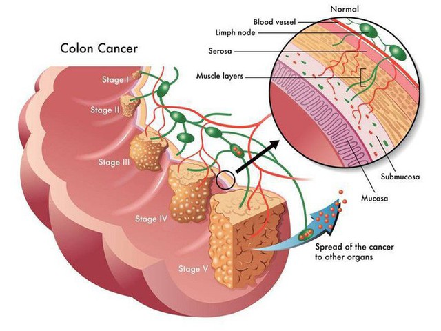 
Các giai đoạn ung thư đại tràng do polyp (Ảnh minh hoạ)
