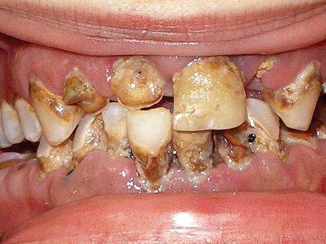 Uống nước ngọt có ga làm mòn lớp men răng tự nhiên, khiến răng bị xỉn màu và là một trong những nguyên nhân gây sâu răng.