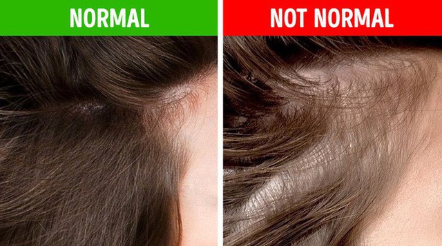 Nếu gặp các biểu hiện này ở tóc, hãy gặp bác sĩ vì rất có thể có điều gì đó không ổn trong cơ thể - Ảnh 5.