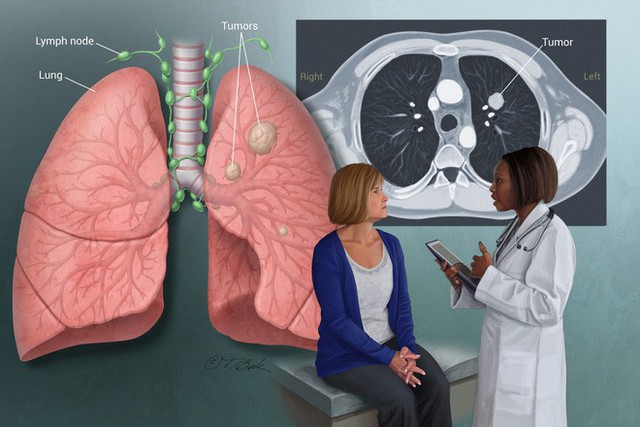 4 việc quan trọng phải làm để ngăn ung thư phổi: Tiếc rằng nhiều người biết quá muộn - Ảnh 3.