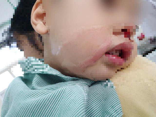  Nhỏ nhầm axit để rửa mũi khiến bé trai bị bỏng nặng  - Ảnh 1.