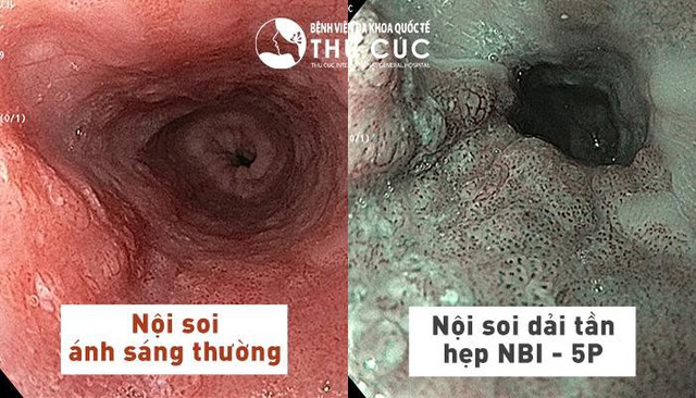 Thoát khỏi “cửa tử” nhờ nội soi đại tràng bằng công nghệ NBI 5P - Ảnh 2.