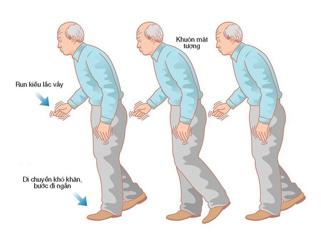 Người cao tuổi bị Parkinson nên biết những điều này - Ảnh 1.