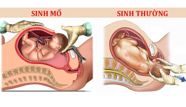 Bất ngờ với lý do lựa chọn cách sinh con của gần 50% thai phụ hiện nay - Ảnh 2.