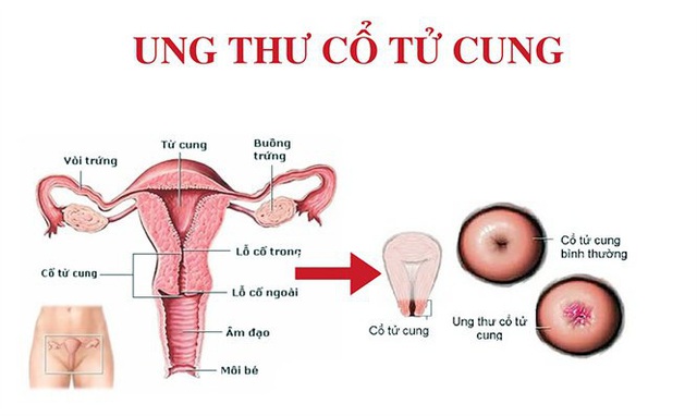 Ung thư cổ tử cung phòng tránh hiệu quả với các kĩ thuật sàng lọc này? - Ảnh 1.