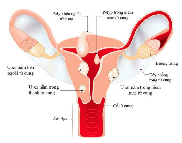 Triệu chứng u xơ tử cung và cách cải thiện hiệu quả nhờ Nga Phụ Khang - Ảnh 2.