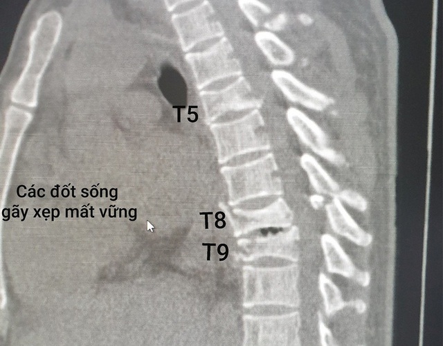 Vật nặng rơi trúng đầu, ngực người đàn ông suýt liệt toàn thân - Ảnh 1.