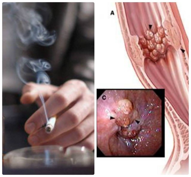 
Hút thuốc lá là thói quen dễ gây ung thư thực quản.
