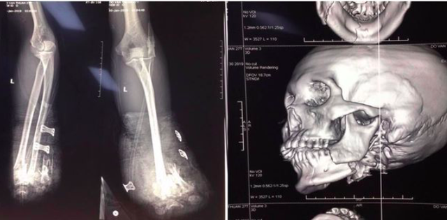 
Hình ảnh X- quang cho thấy, bệnh nhân bị mỏm cụt dâp nát 1/3 dưới 2 xương cẳng tay và gẫy xương hàm dưới trái trên phim CLVT hàm mặt.
