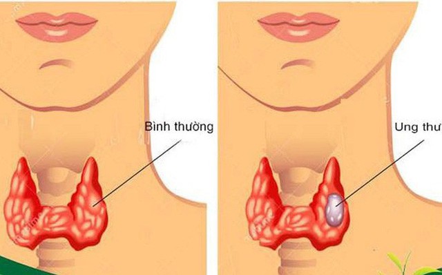 
Dấu hiệu ung thư tuyến giáp
