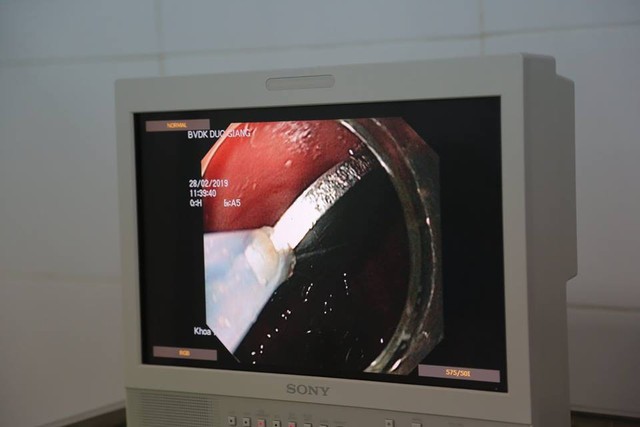 Bệnh viện chụp phim Xquang vùng ngực - cổ để xác định vị trí dị vật. Ảnh: BVCC