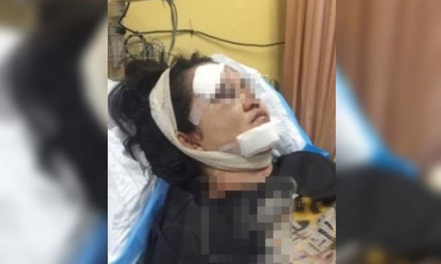 Khuôn mặt nạn nhân bị thương tổn nặng sau khi bị chính bố đẻ nện búa vào mặt